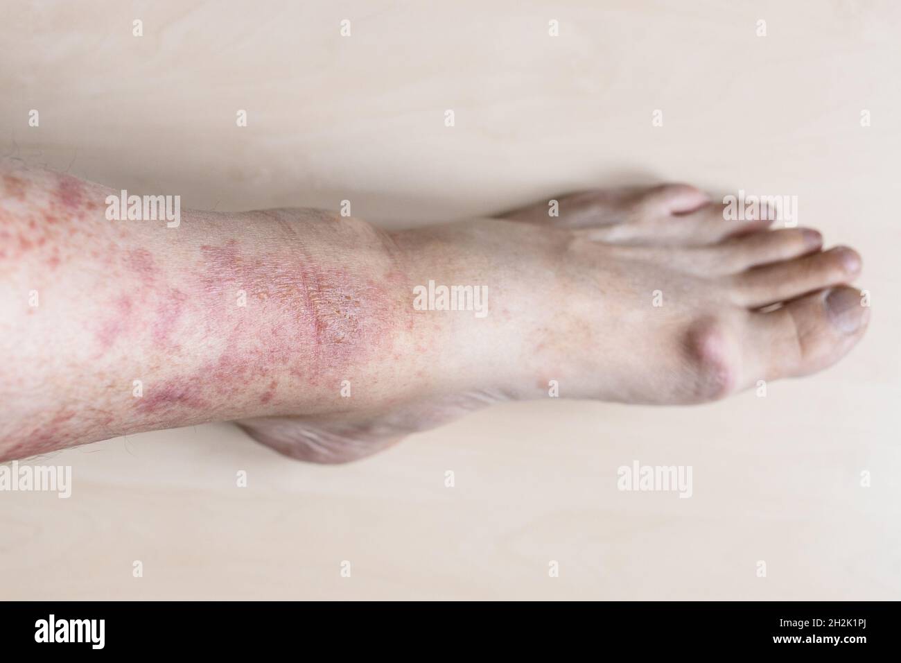 sample of Allergic contact dermatitis - male shin with redness and itchy rash on skin Stock Photo