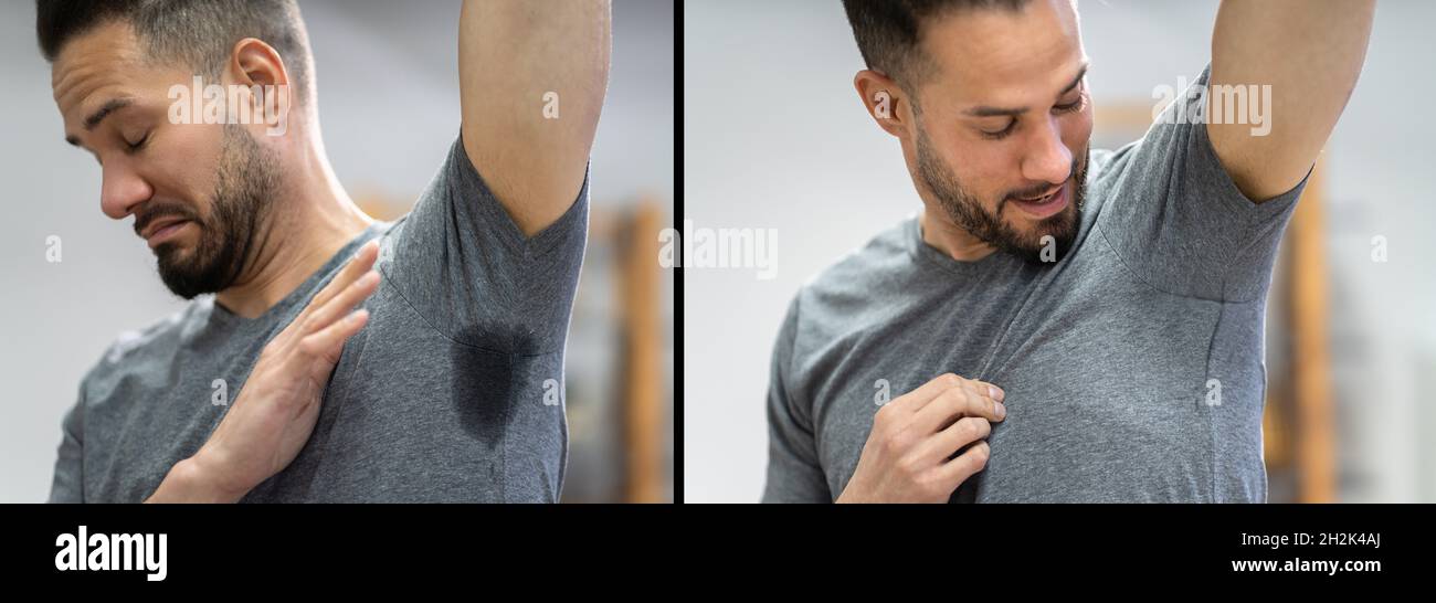 Man With Hyperhidrosis Sweating Before And After Stock Photo