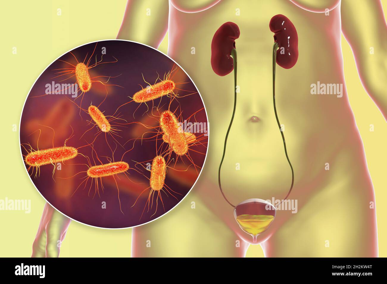 Bacterial cystitis, illustration Stock Photo - Alamy
