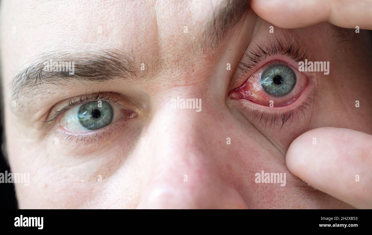 Doctor Looks at Male Patient with Red Inflamed Eyes with Conjunctivitis Stock Photo