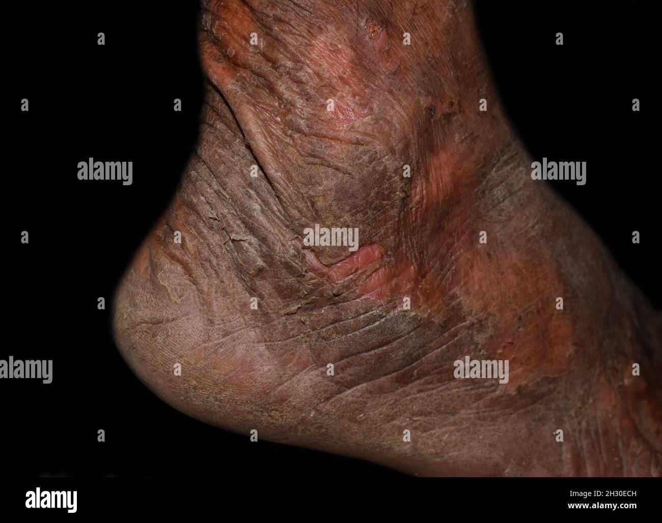 Dry and scaly skin, and abrasions in foot of Asian, Burmese man. Dermatitis foot. Stock Photo