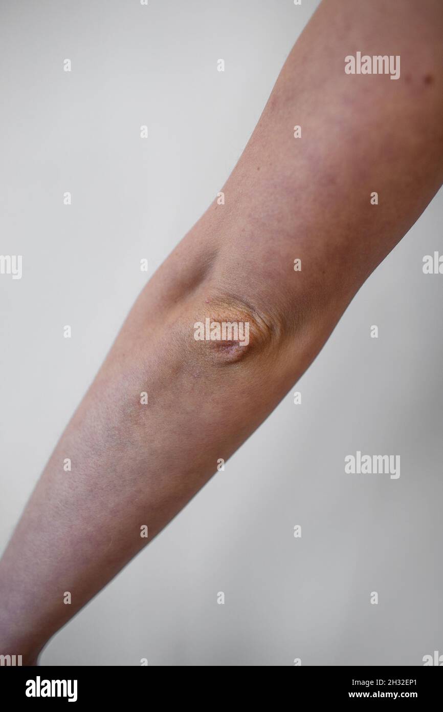 Hypermobile ehlers danlos syndrome skin hires stock photography and