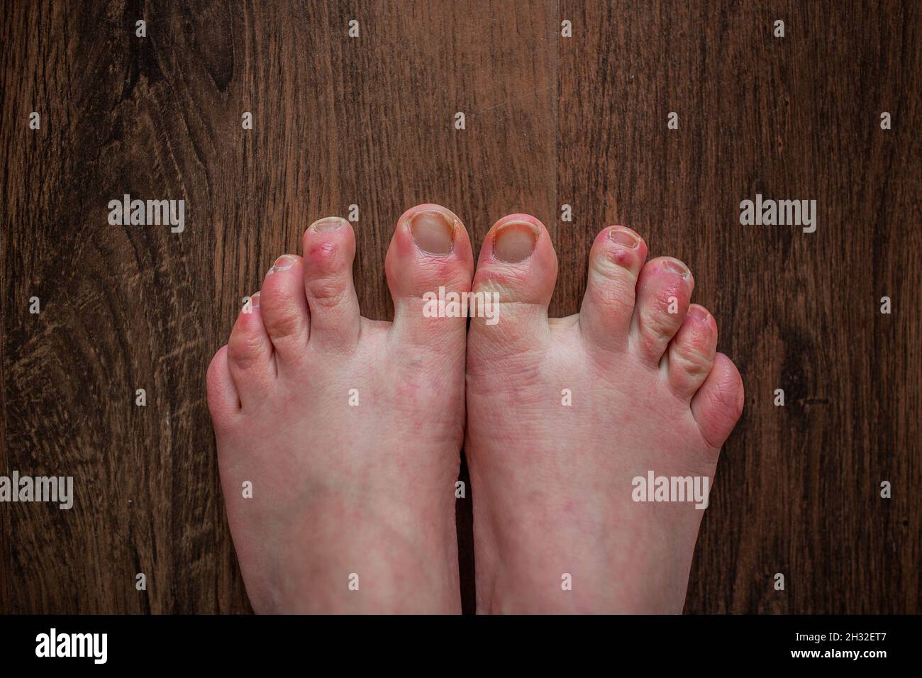Raynaud's disease feet hi-res stock photography and images - Alamy