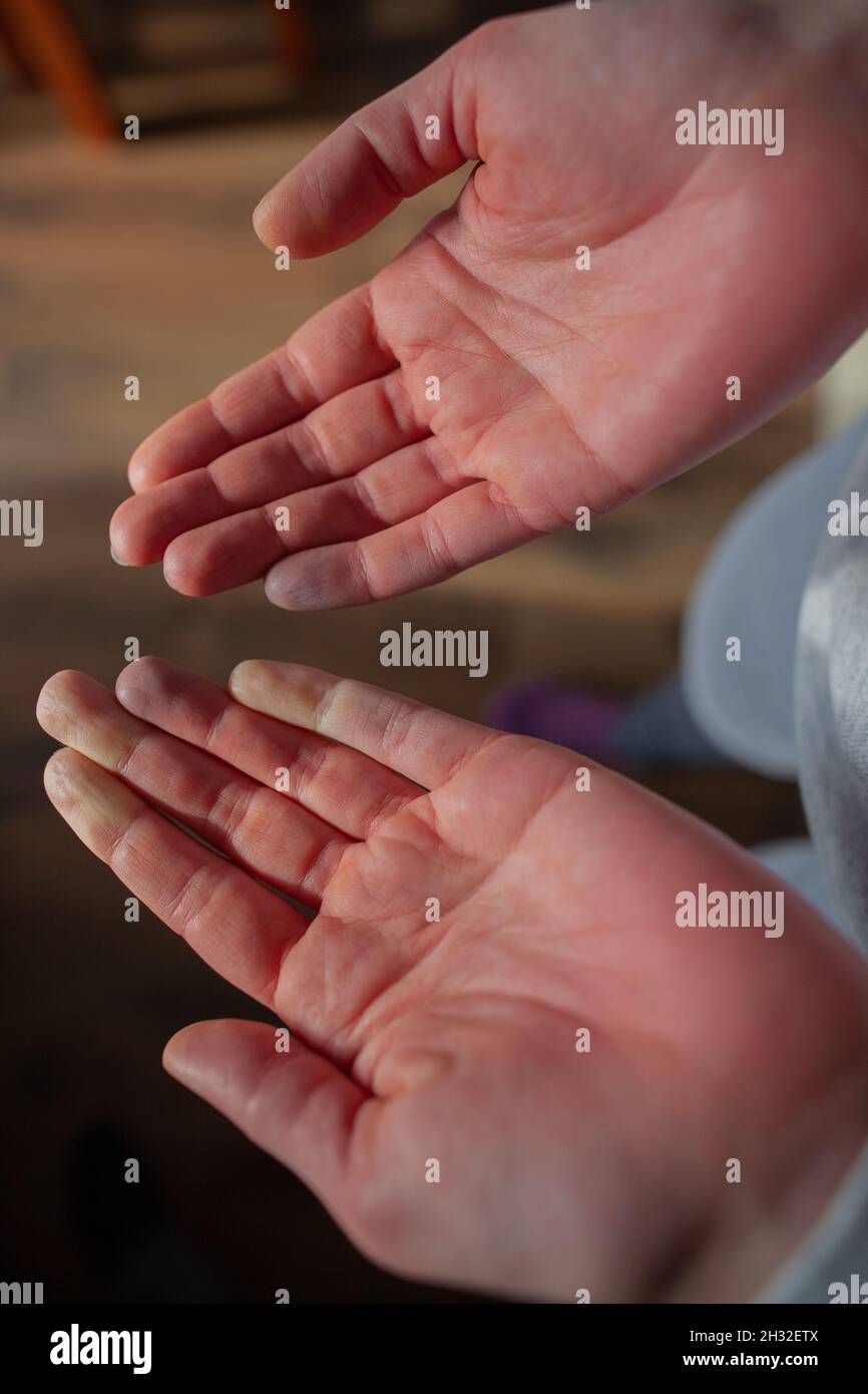 Hands of person with Raynaud's phenomenon after attack, affected part turning blue after white then red Raynaud’s syndrome Raynaud disease Stock Photo