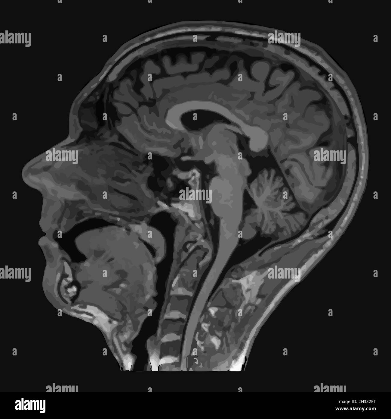 Realistic image sagittal of male head with CT scan, MRI Magnetic resonance imaging layer of head. Isolated on dark background. Vector illustration. Stock Vector