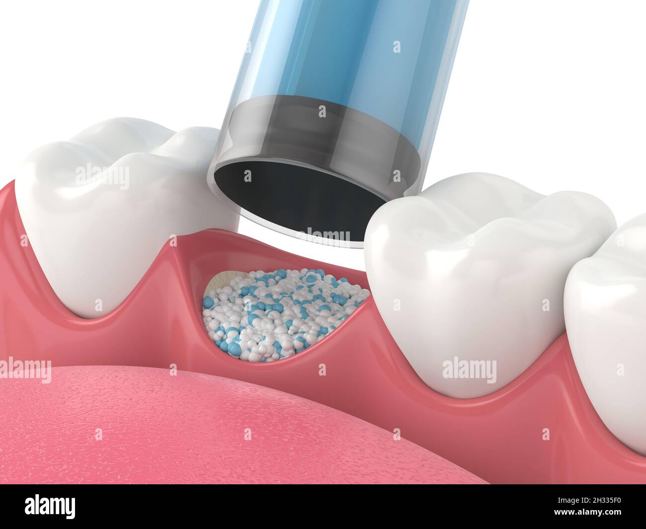 3D render of dental bone grafting with dental bone biomaterial