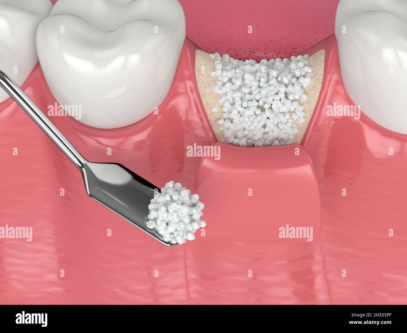3D render of dental bone grafting with bone biomaterial application over white background. Jaw
