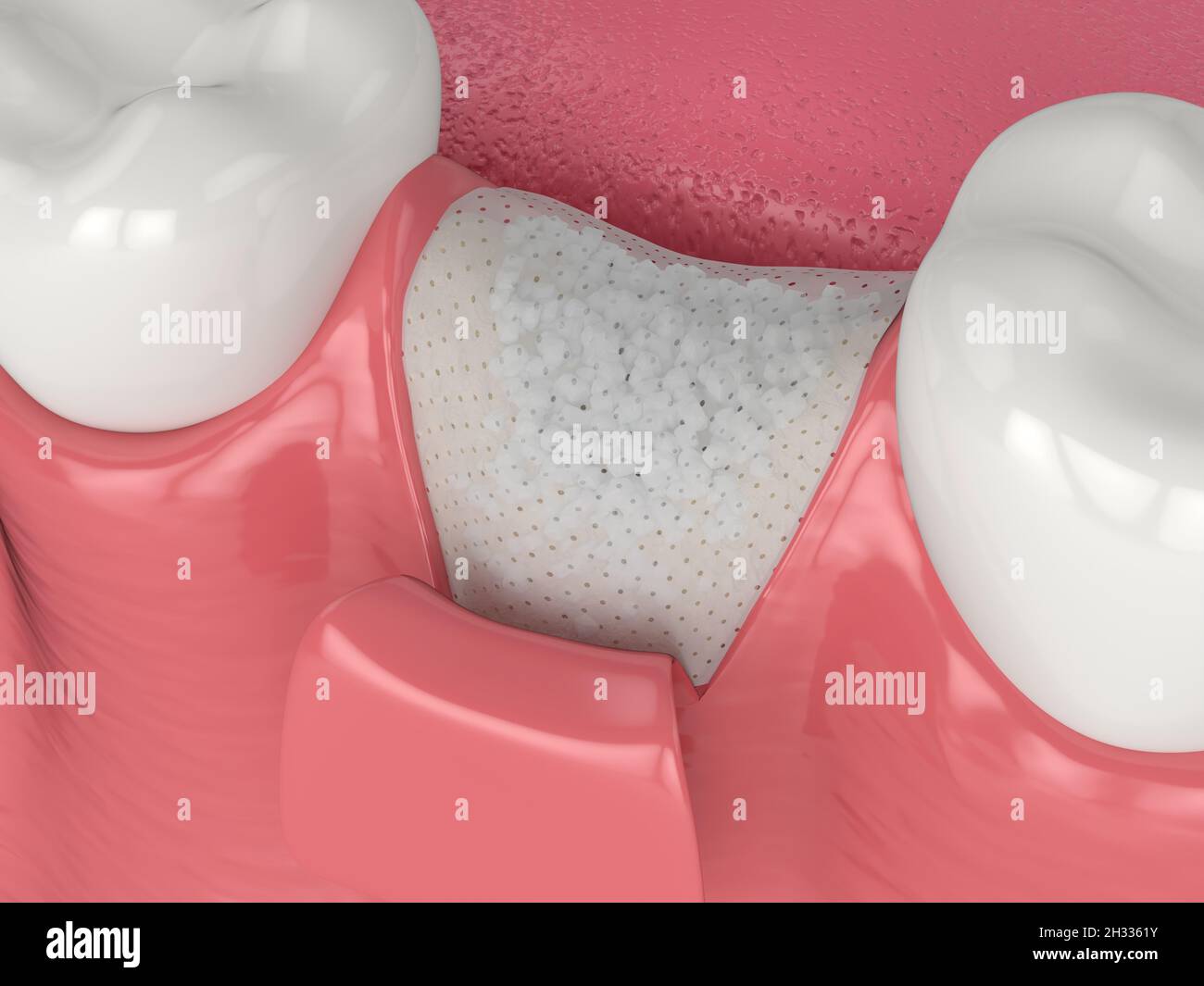 3D render of dental bone grafting with bone biomaterial and membrane over white background. Jaw