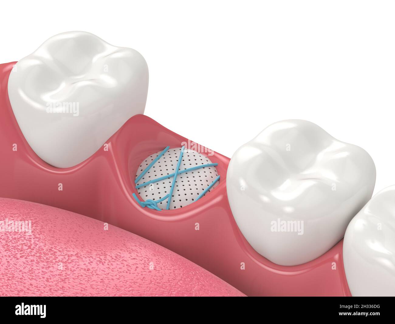 3D render of dental bone grafting with membrane and sutures over white