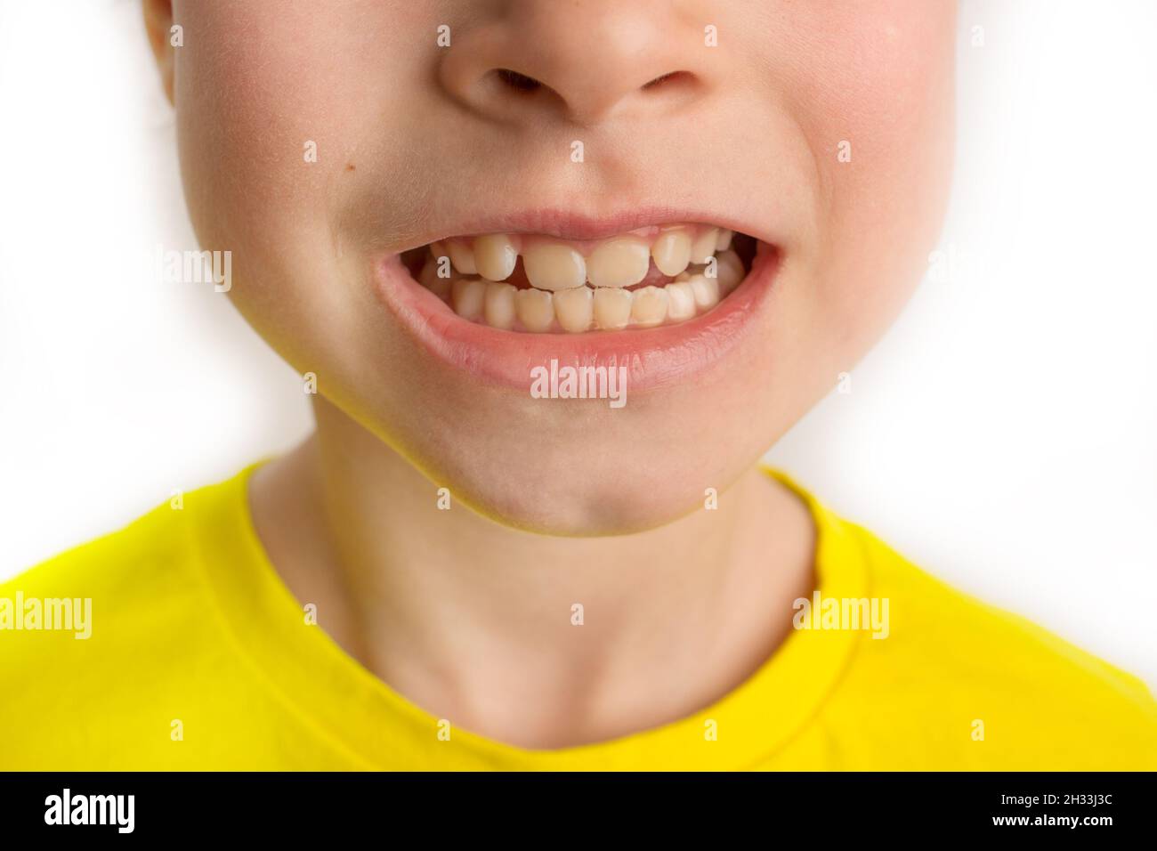 Children crooked teeth, paediatric dentistry. Crooked teeth close up