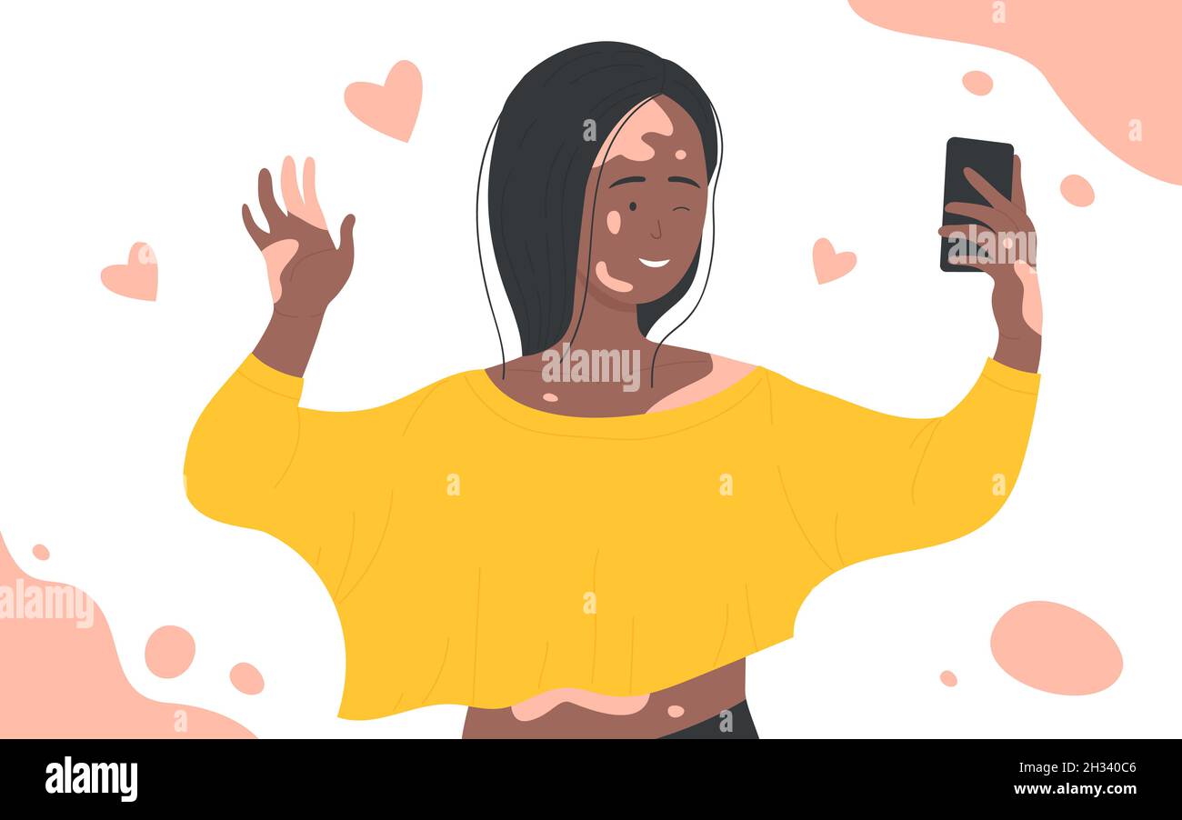 Skin problems vitiligo vector illustration. Cartoon happy girl