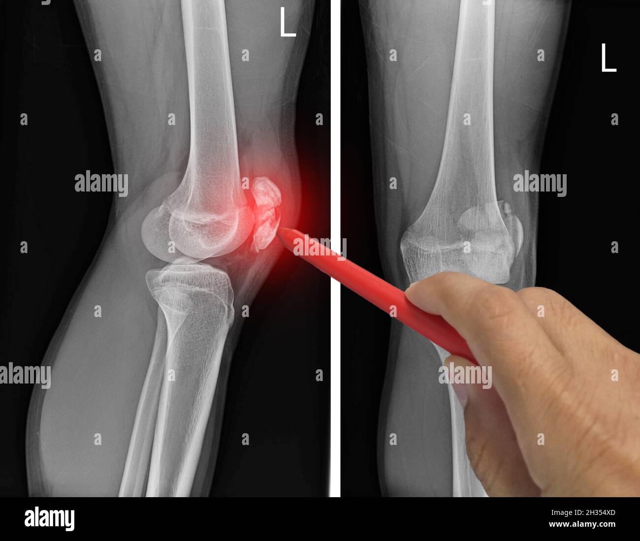 Close up Xray knee APLateral showing fracture patella or knee cap