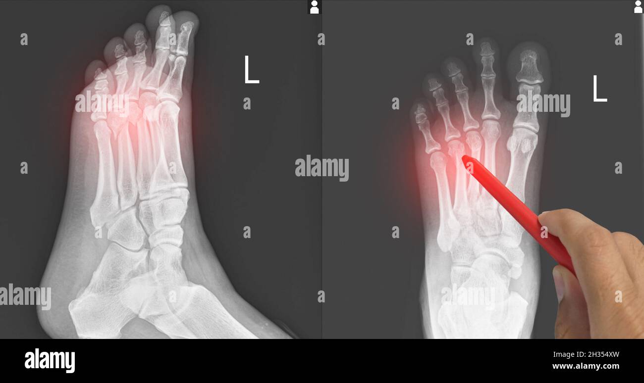 Close up X-ray Foot  AP-Lateral showing fracture 3th,4th metatarsal bone, Doctor holding a red pen point , symptoms medical healthcare concept. Stock Photo
