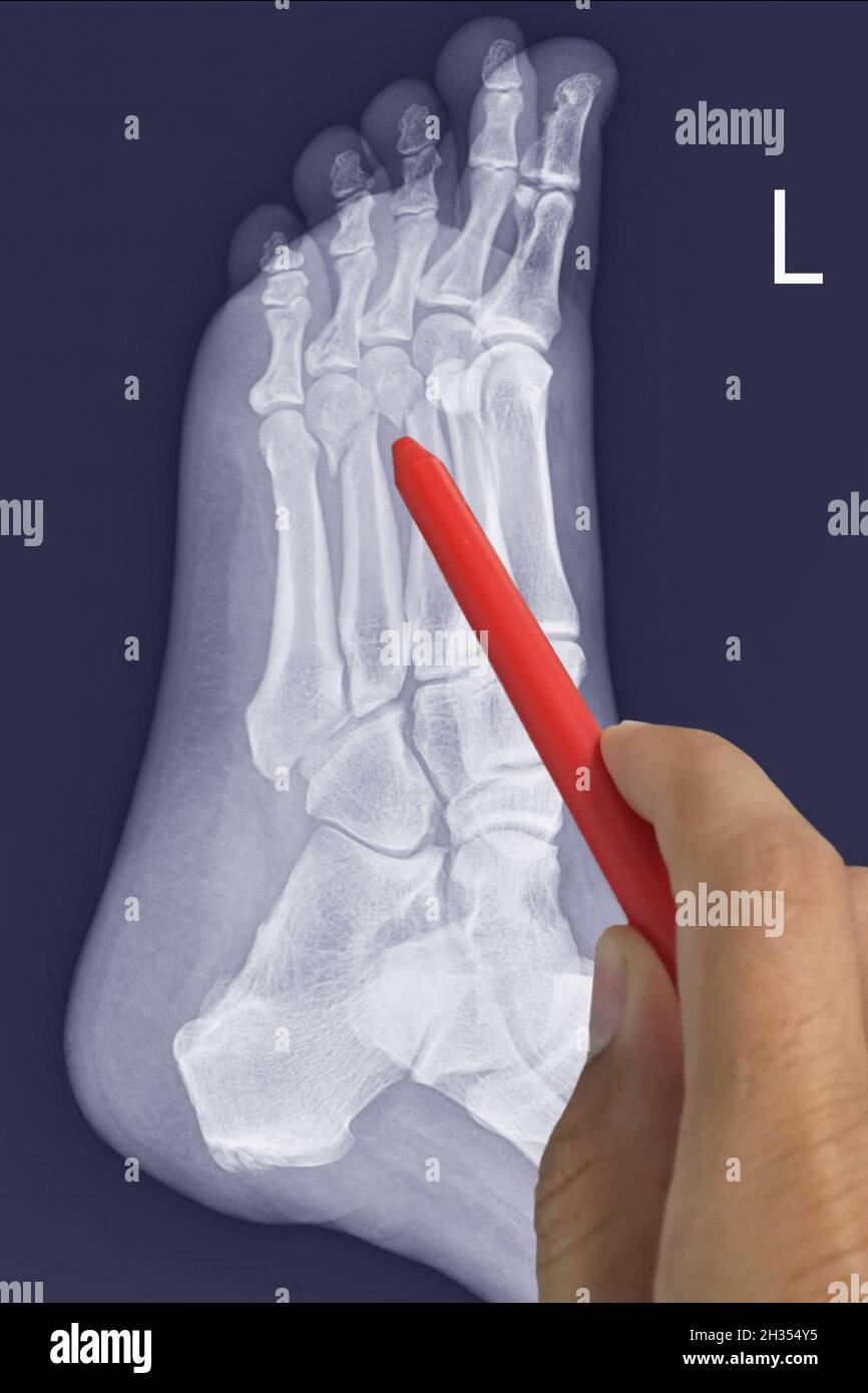 Close up X-ray Foot Lateral showing fracture 3th,4th metatarsal bone, Doctor holding a red pen point , symptoms medical healthcare concept. Stock Photo
