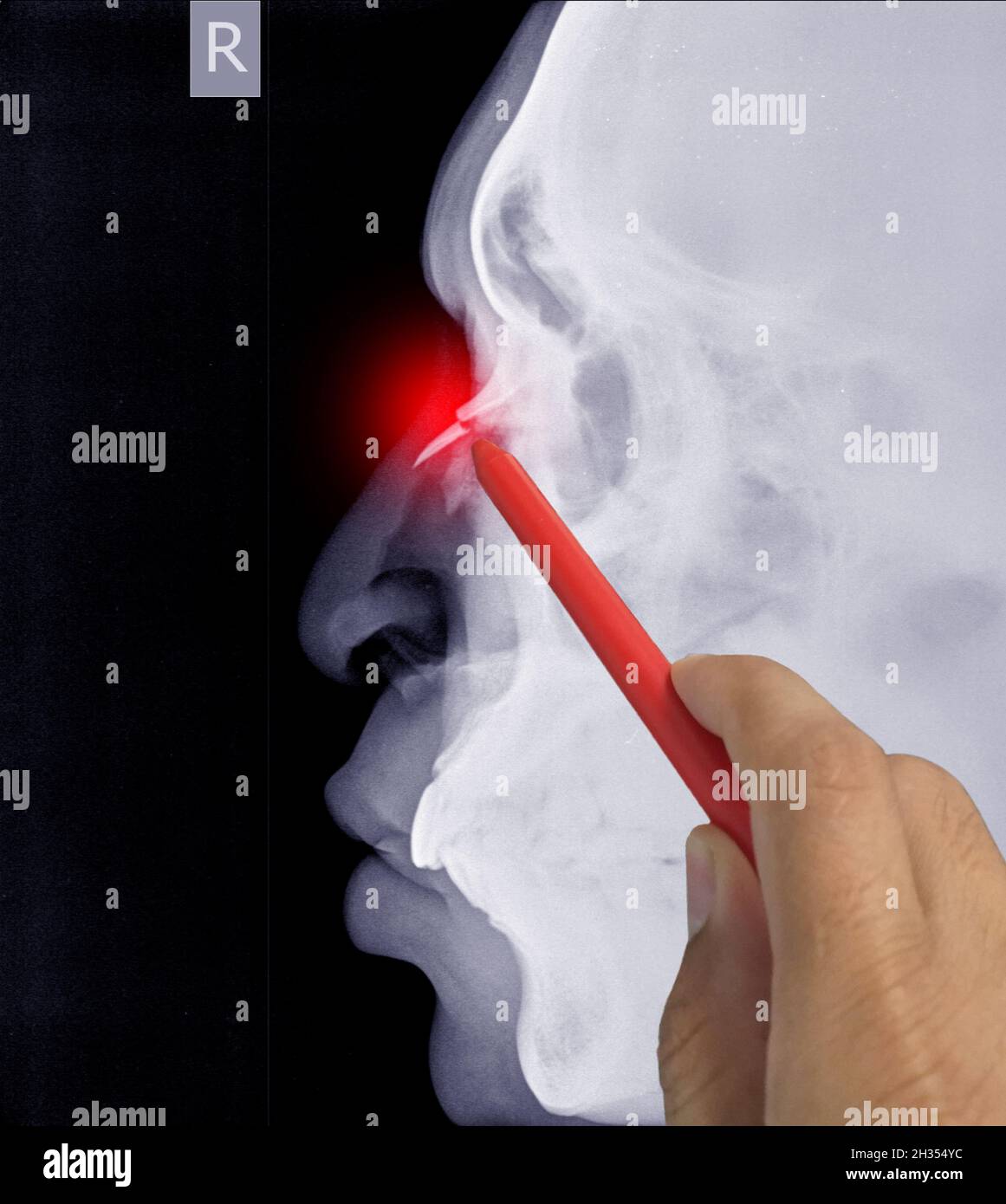 Close up X-ray Nasal bone Lateral showing fracture nasal bone, Doctor holding a red pen point, symptoms medical healthcare concept. Stock Photo