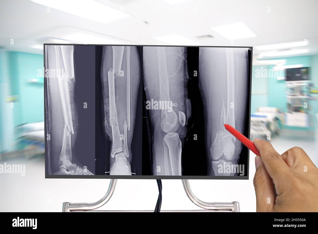 Close up X-ray whole leg bone showing fracture multiple fractures bone, Doctor holding a red pen point , symptoms medical healthcare concept. Stock Photo