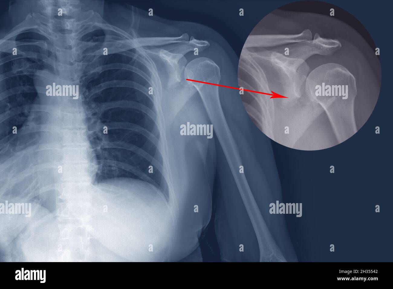 X-ray shoulder Fracture posterior half of glenoid with posterior dislocation of the bone fragment. Irregular transverse fracture at body of scapula. Stock Photo