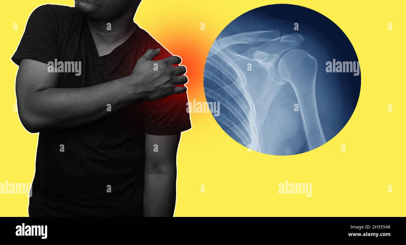 Close up Shoulder and clavicle fracture pain in a man, Young man holding his shoulder in pain Shoulder inflammation symptoms medical healthcare concep Stock Photo