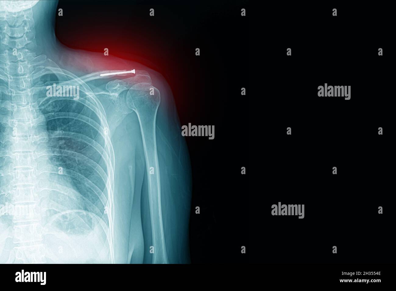 x-ray image of shoulder pain with clavicle fracture with post-op and screw medical healthcare concept.copy space Stock Photo