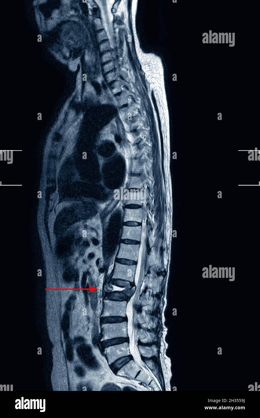 MRI LS-spine  Showing Burst fracture of L2 vertebral body with severe vertebral collapse,Medical image concept. Stock Photo