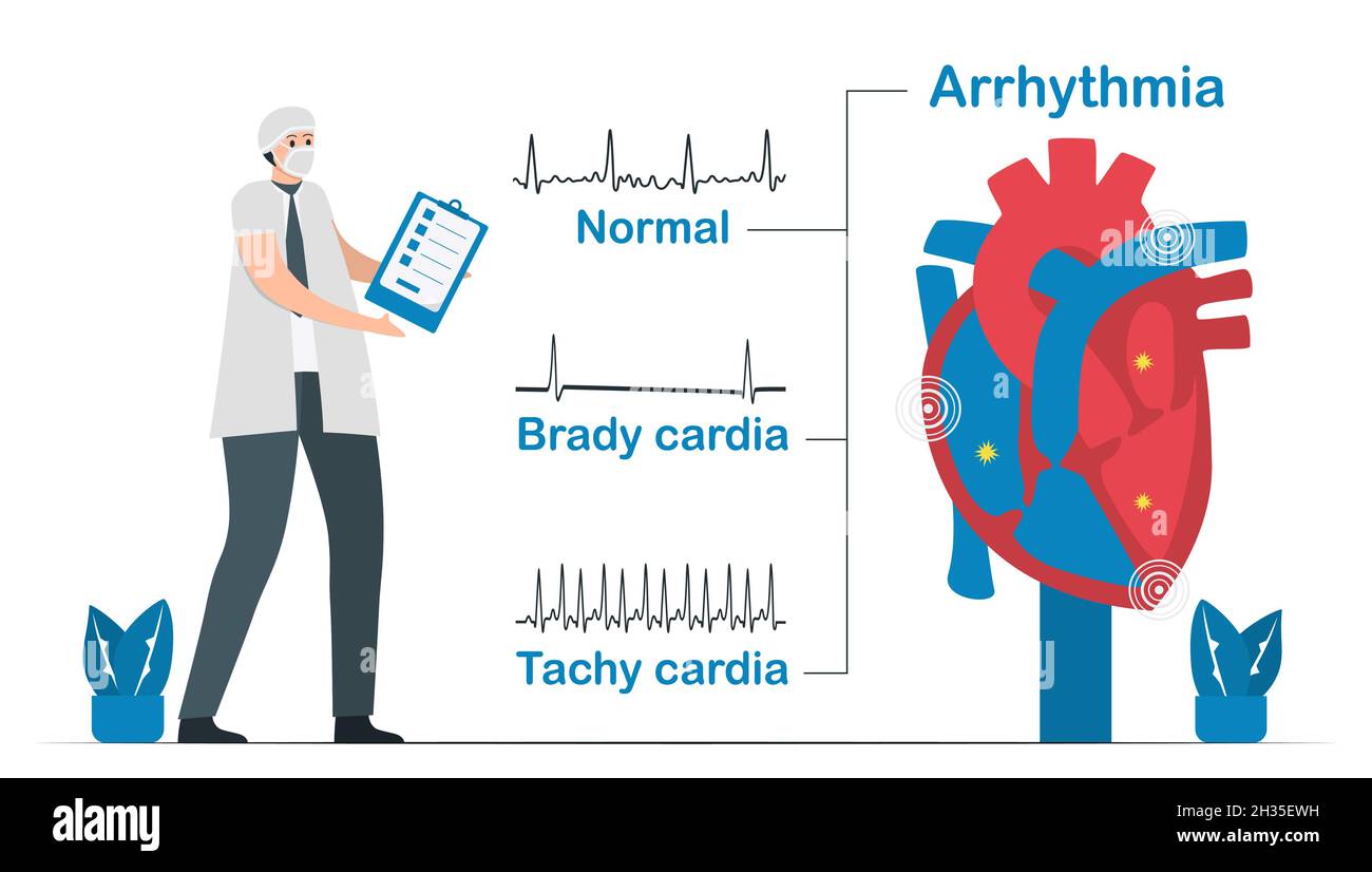Normal heart signal is compared with 2 types of arrhythmia. It includes tachycardia and bradycardia. Cardiology vector illustration isolated on white Stock Vector