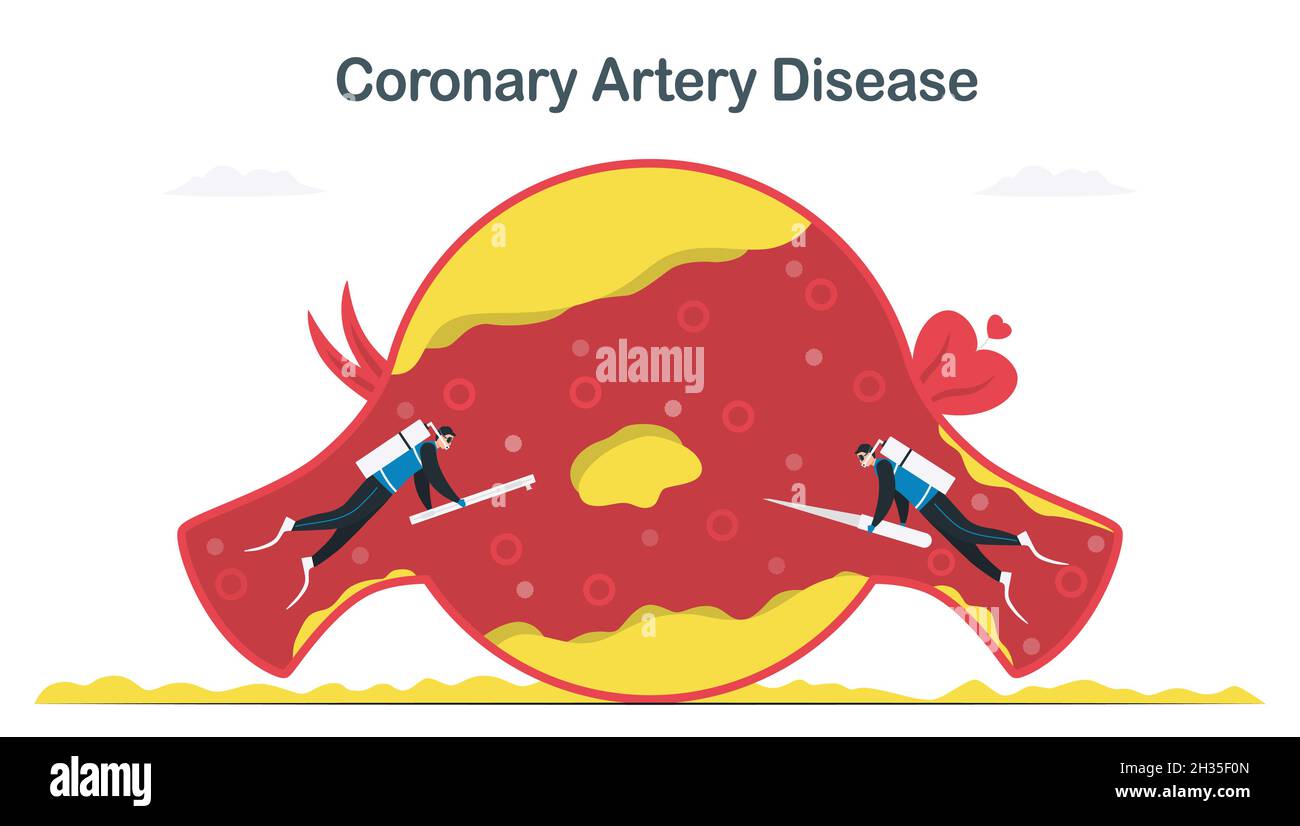 Coronary artery disease treatment that caused by atherosclerosis. More cholesterol and fatty deposits in blood vessel. Cardiology vector illustration Stock Vector