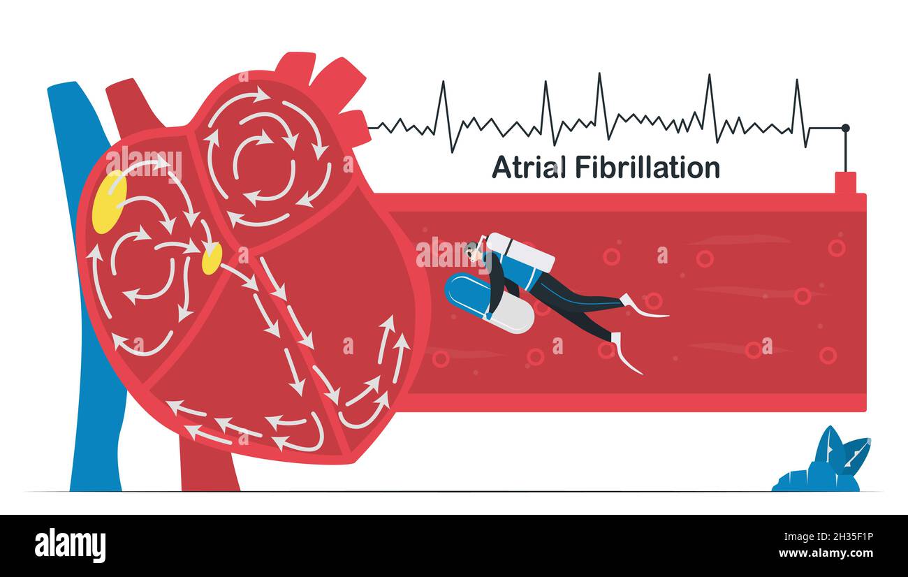 Doctor treats a heart disease that is atrial fibrillation. AF is common type of irregular heartbeat. Electrical signals in atrium cause atrium to beat Stock Vector