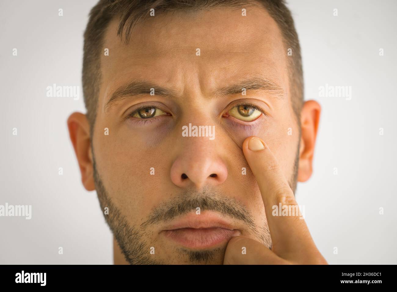 Sick man with yellow eyes. Liver disease. Problems with liver. Jaundice Stock Photo