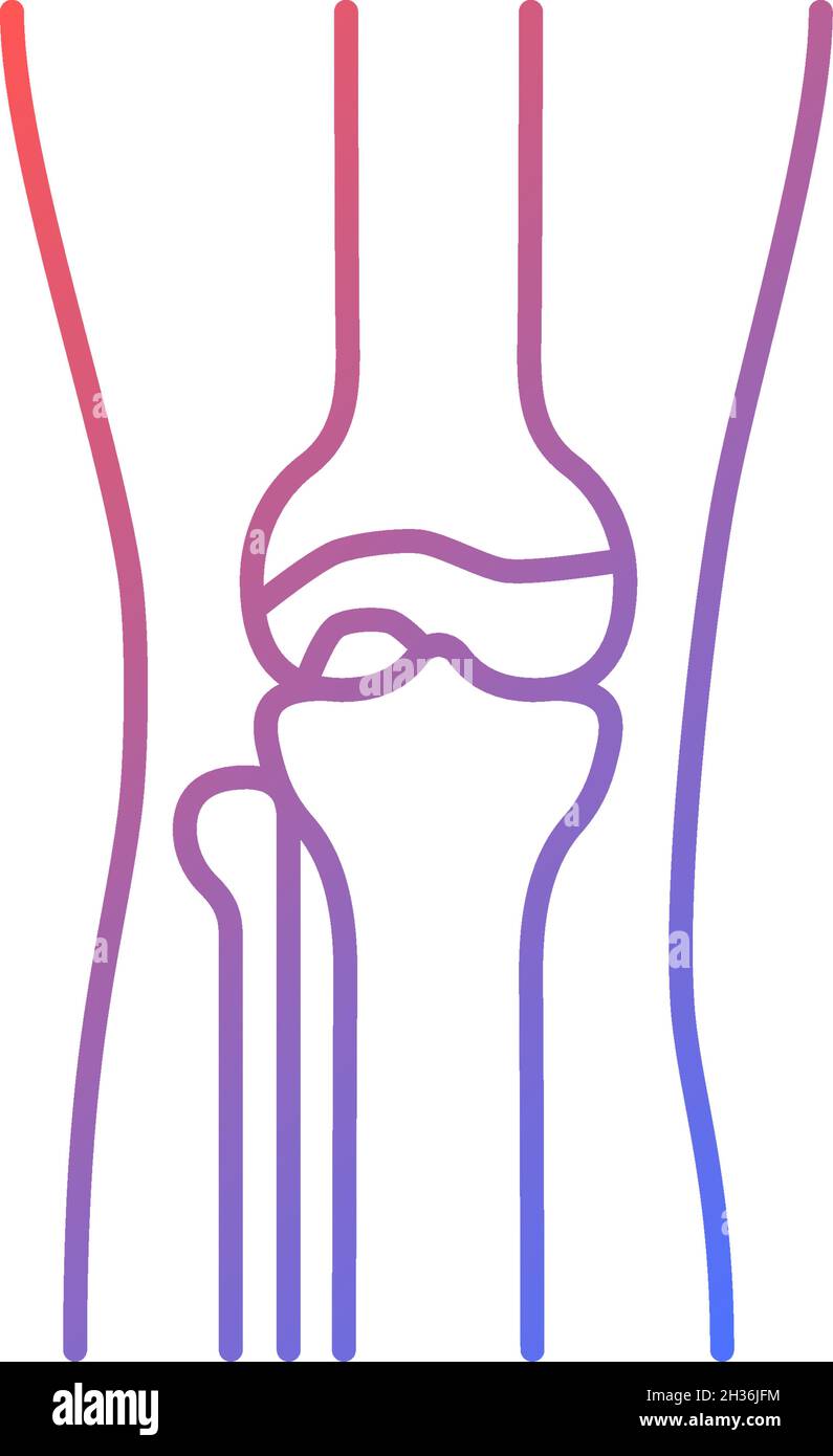 Osteoarthritis gradient linear vector icon Stock Vector