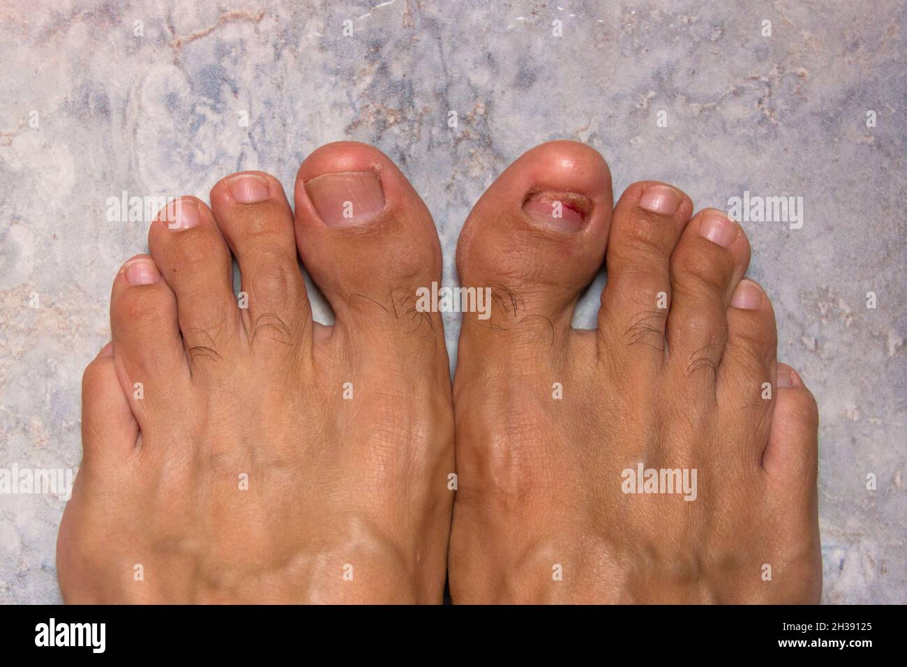 Fungus on big toe nail. Feet of man together on blue floor. Medical, health care, podiatrist concepts Stock Photo