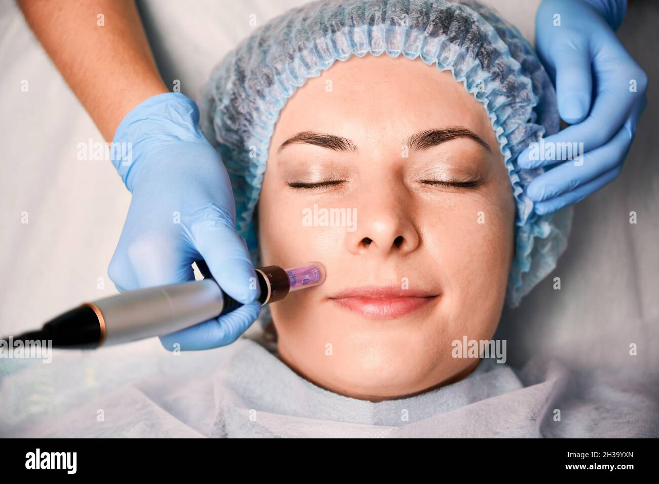 Close up of beautician hands in sterile gloves using dermapen during