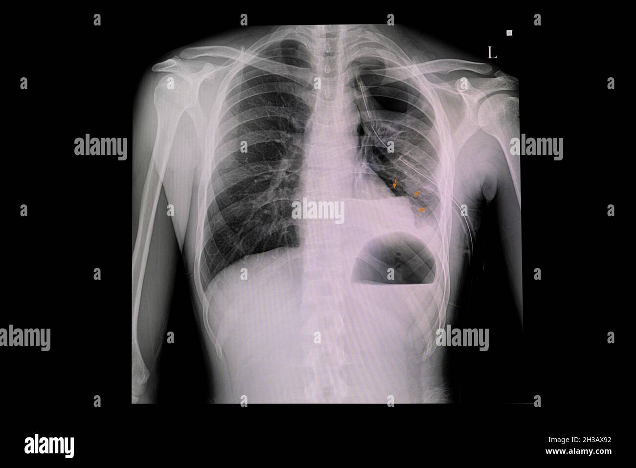 Pneumothorax hemothorax hi-res stock photography and images - Alamy