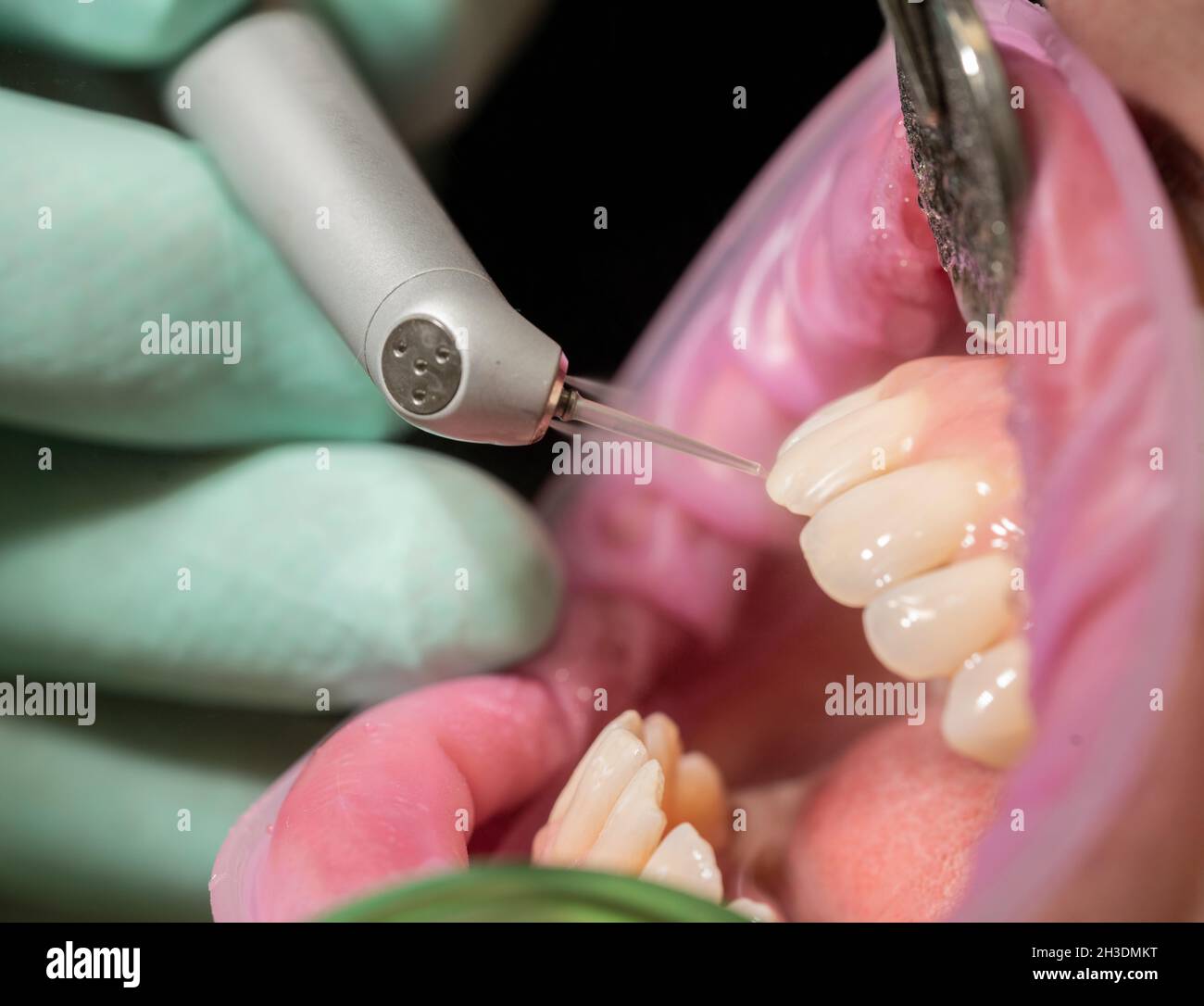 Closeup of laser etching teeth procedure for Direct Bonding of