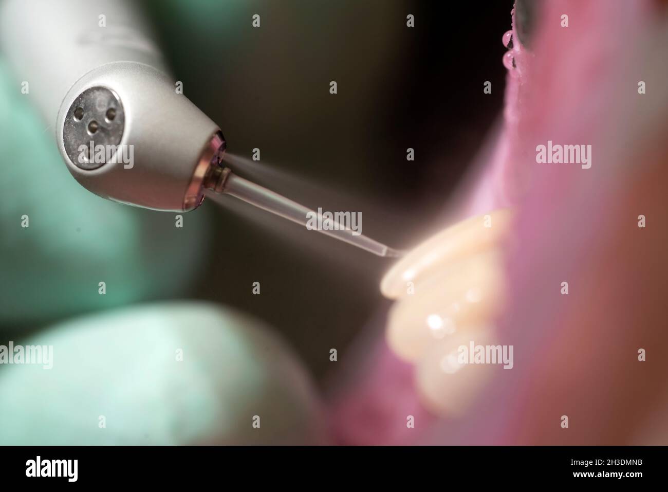 Closeup of laser etching teeth procedure for Direct Bonding of