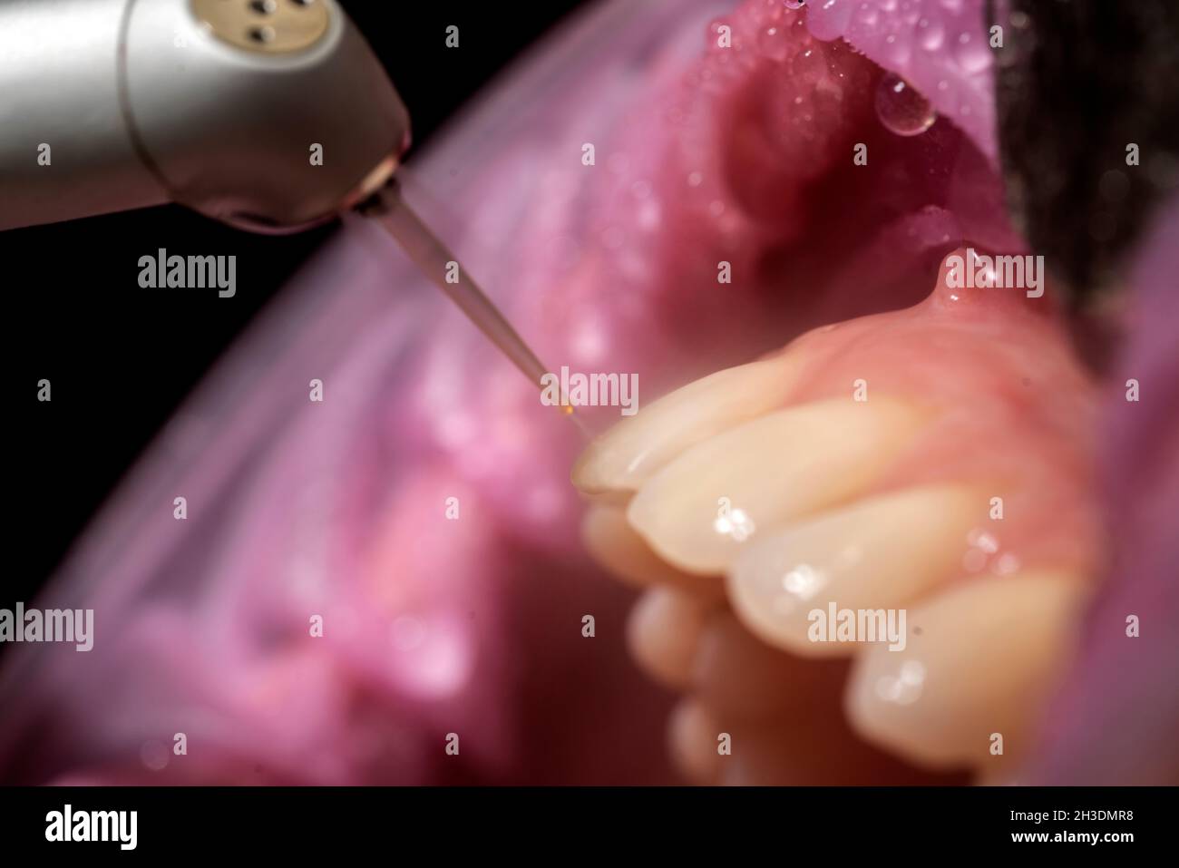 Closeup of laser etching teeth procedure for Direct Bonding of