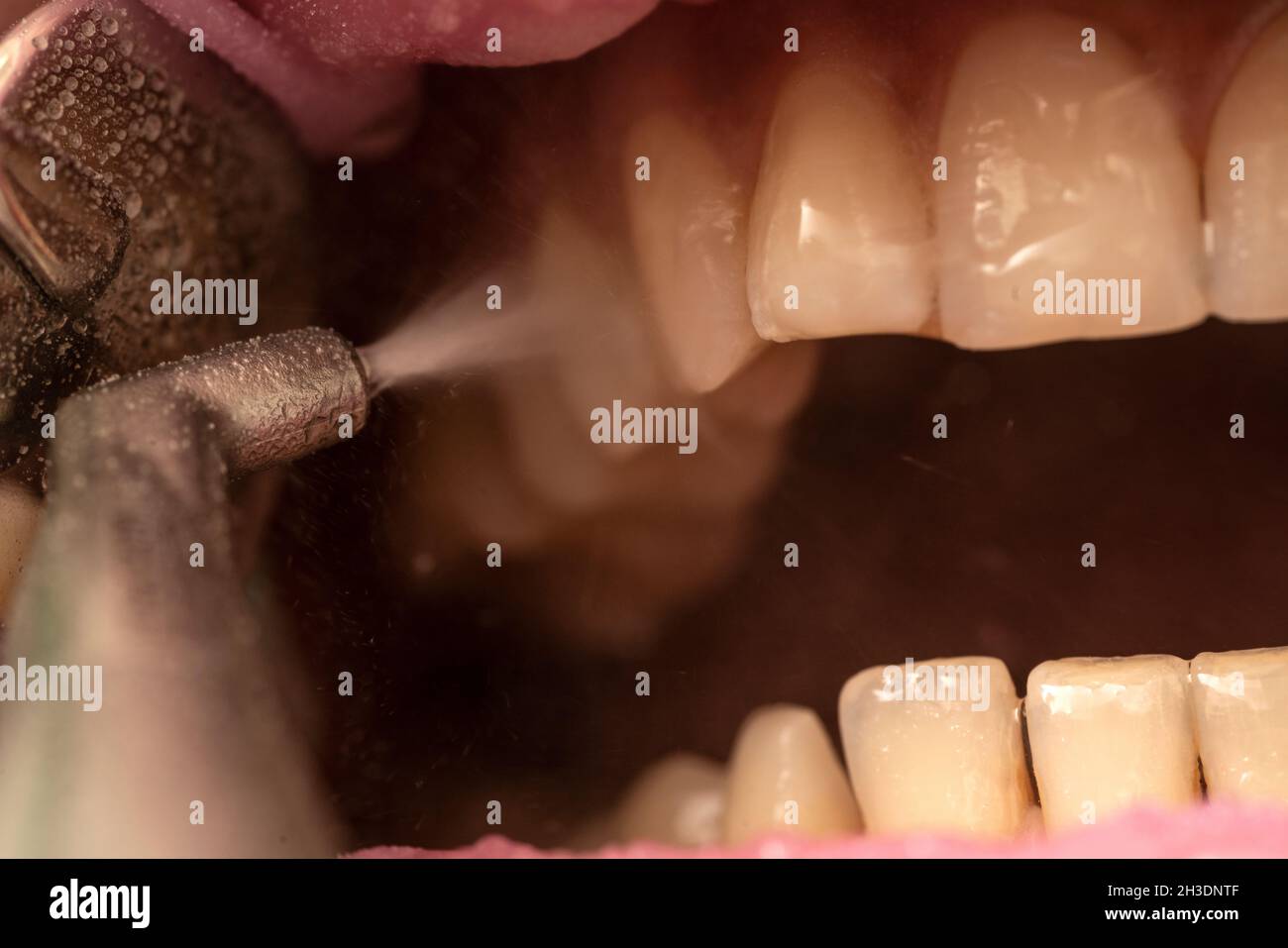 Closeup of teeth sandblasting, tartar cleaning and whitening Stock