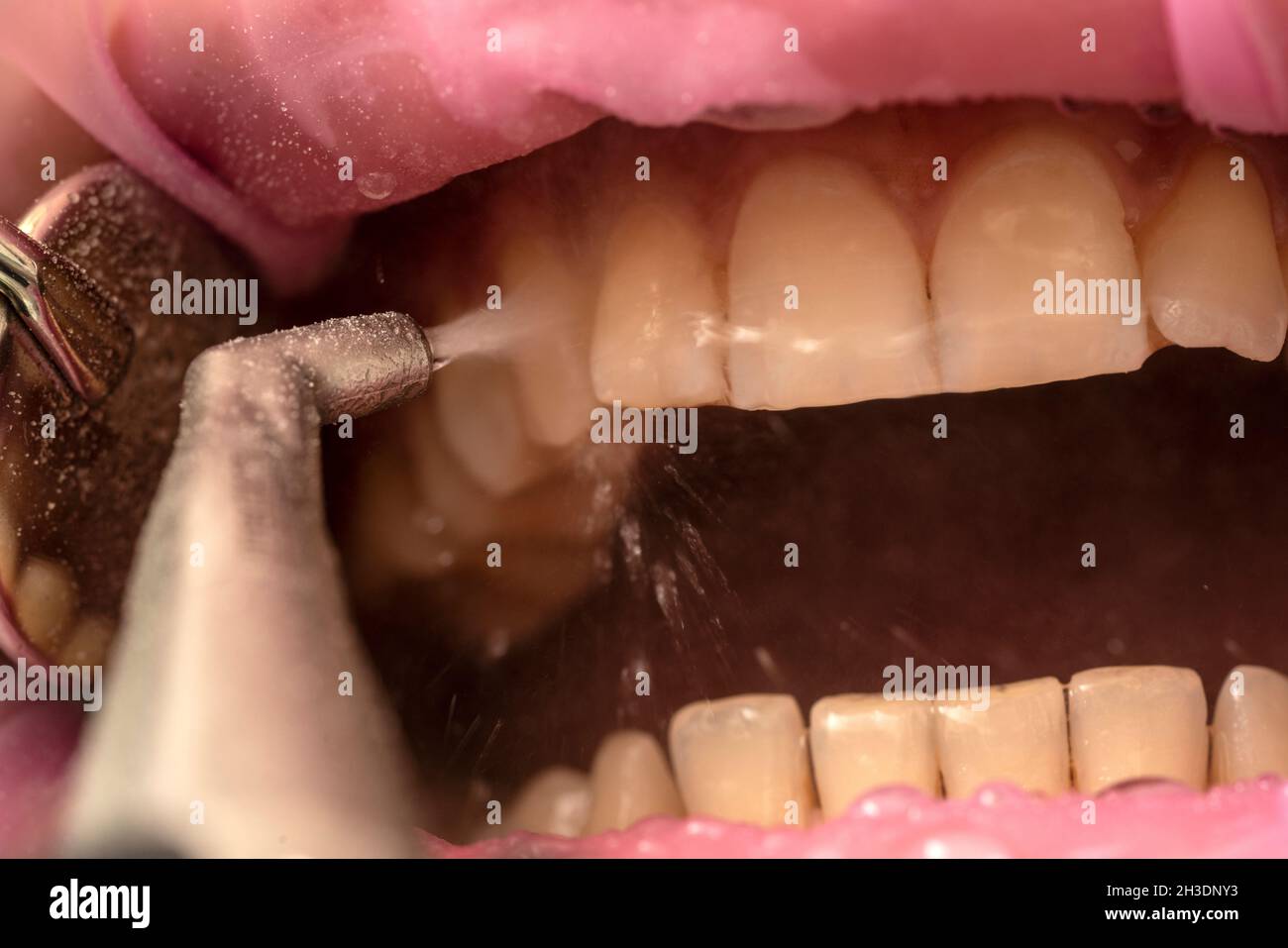 Closeup of teeth sandblasting, tartar cleaning and whitening Stock