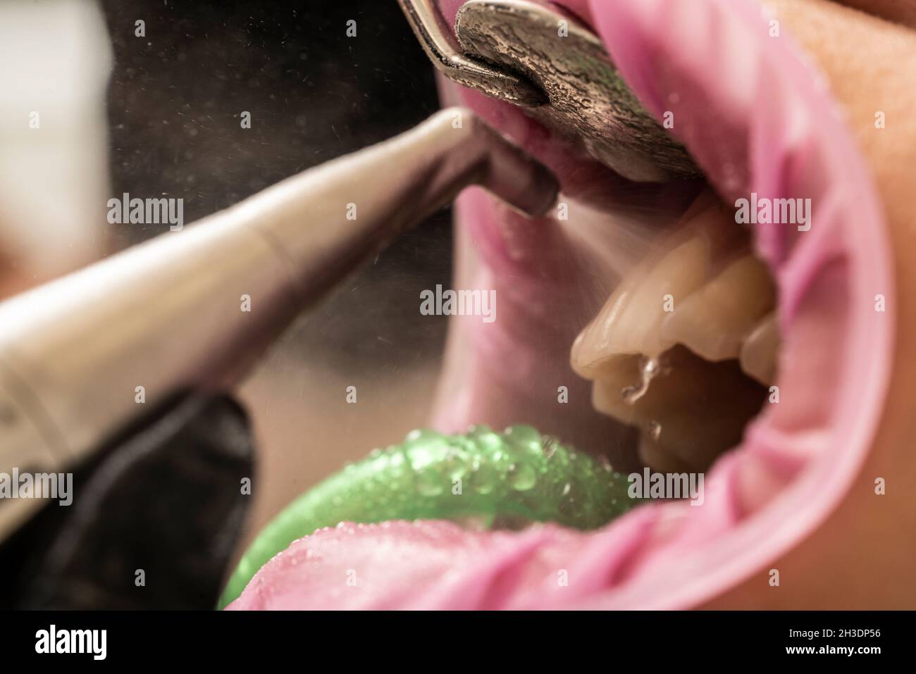 Tartar teeth human hires stock photography and images Alamy