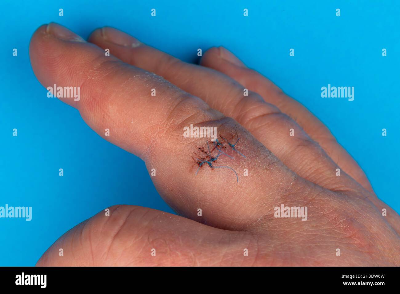 Postoperative sutures on the finger of the hand.. Stitches on the injured finger. Photo taken under artificial light Stock Photo