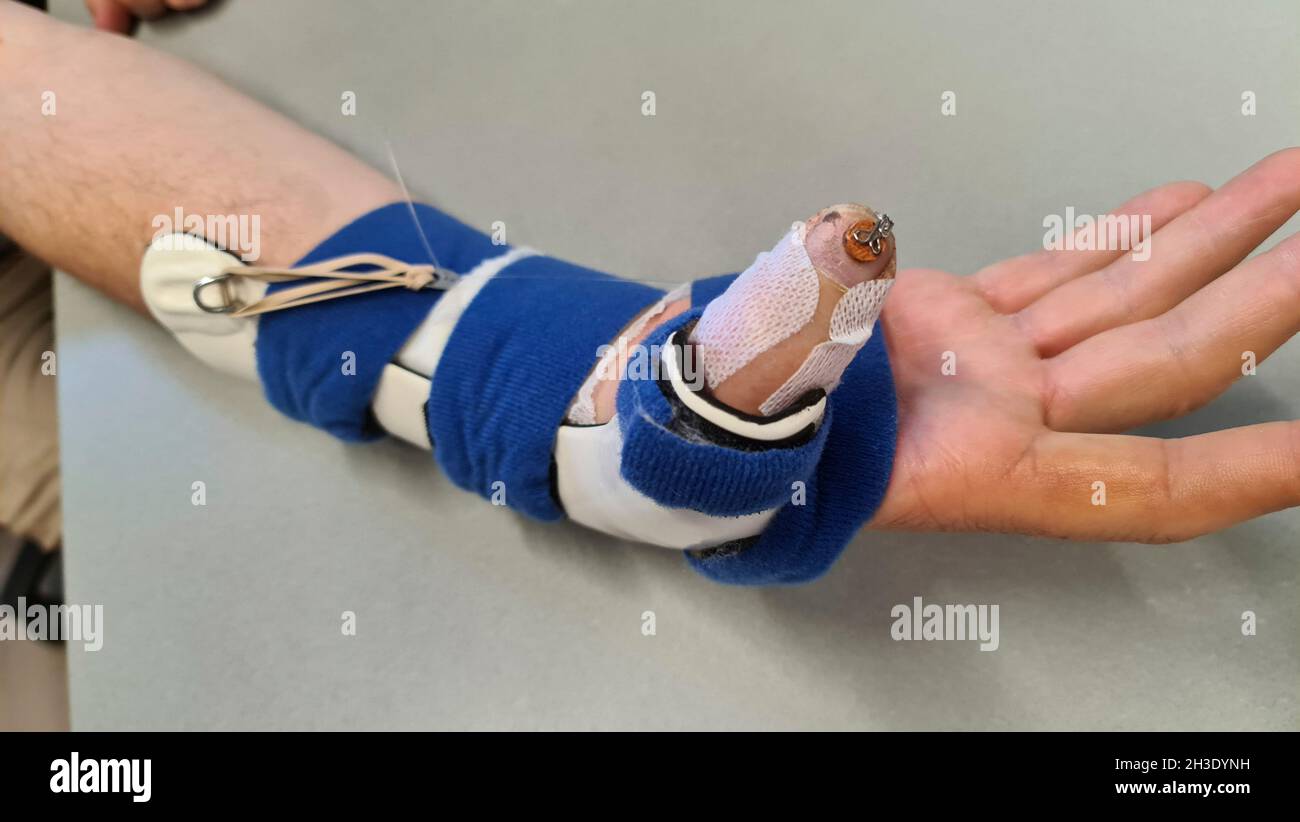hand with splint after cut of the flexor tendon of the thumb Stock Photo Alamy