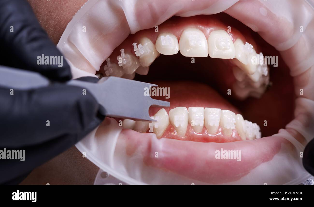 Close up of orthodontist using aluminum bracket gauge while attaching