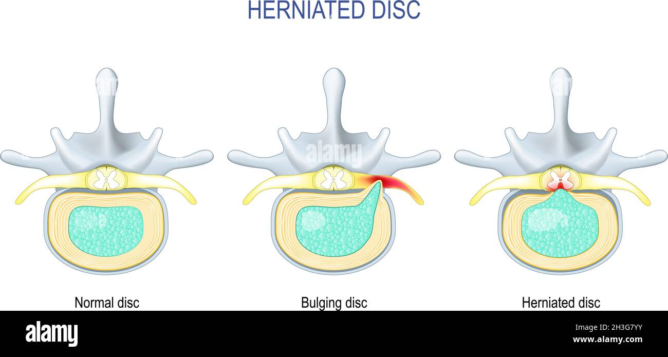 Spinal disc herniation. Difference Between Bulging disc and Herniated Disc. Vector illustration Stock Vector