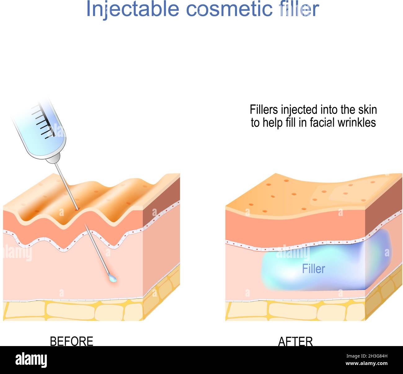 cosmetic filler injectable. Skin with wrinkles before injecting of hyaluronic acid, and Skin layers after Medical procedure. anti-aging therapy. Fille Stock Vector