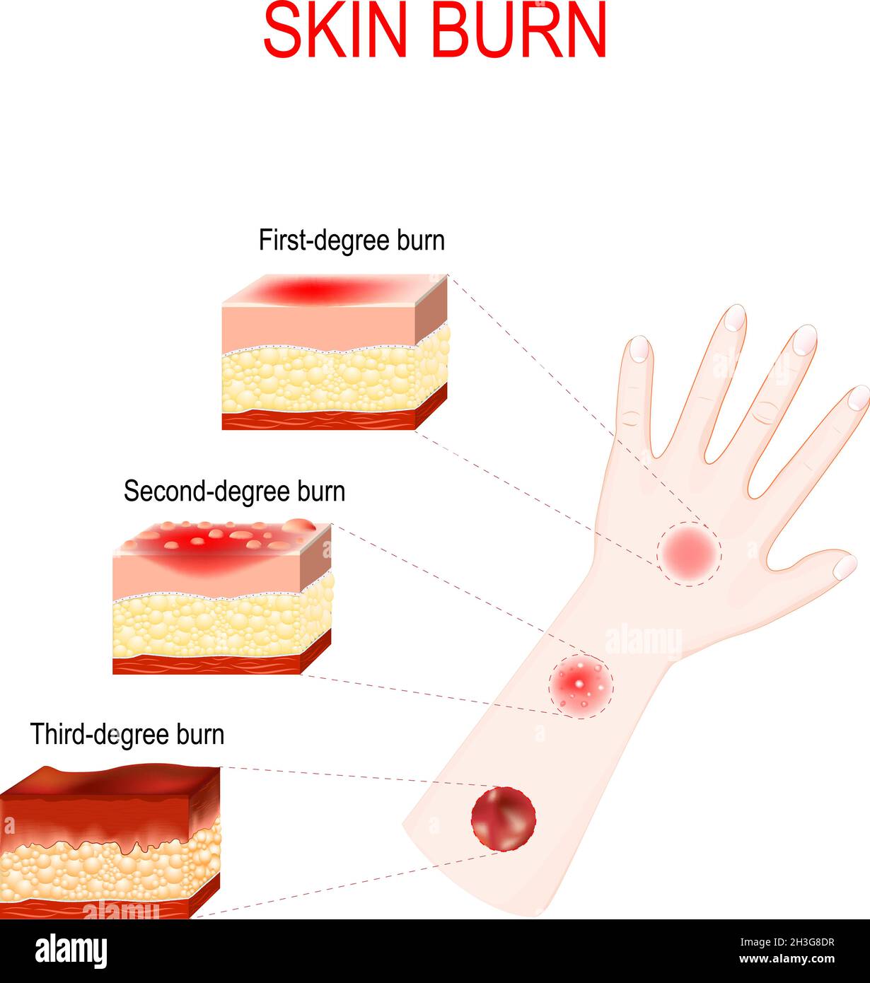 types of burns. Cross section of humans skin with First, Second and Third-degree burn. Close-up of hand with magnification of wound after burn. Vector Stock Vector