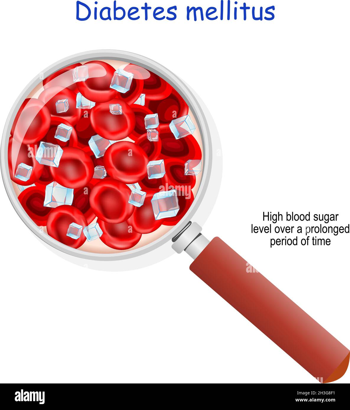 Diabetes mellitus. High blood sugar level over a prolonged period of time. magnifying glass. Close-up of blood flow with red blood cells and glucose Stock Vector