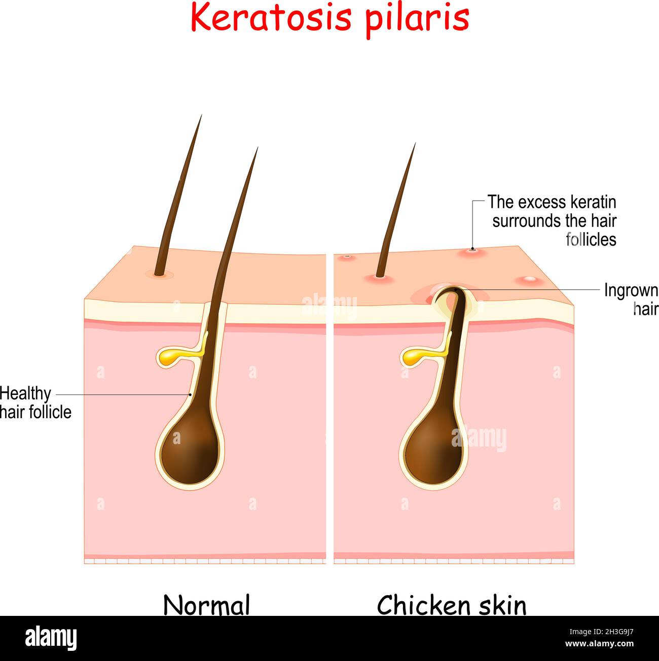 Keratosis pilaris. lichen pilaris and hair follicle. comparison and difference between healthy skin, and follicular keratosis. Skin disorder Stock Vector