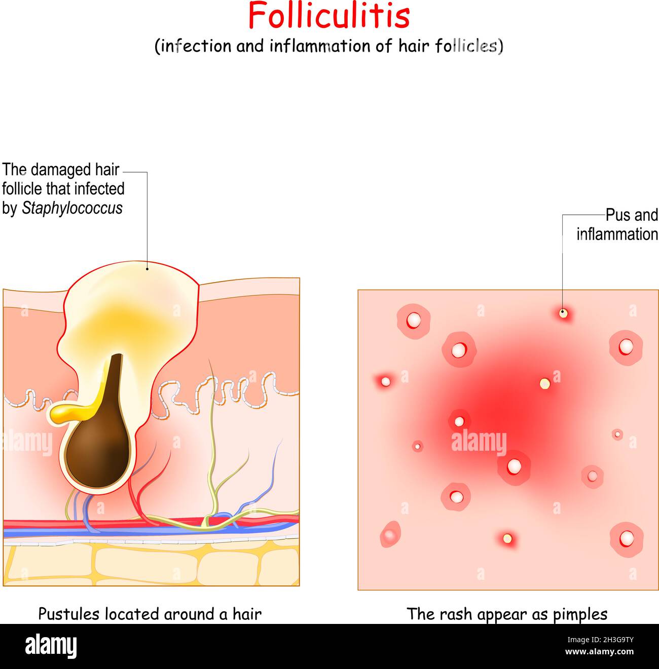 Hair follicle infection hi-res stock photography and images - Alamy