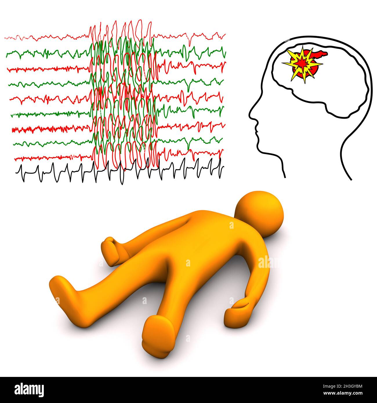 Epileptic fit hi-res stock photography and images - Alamy