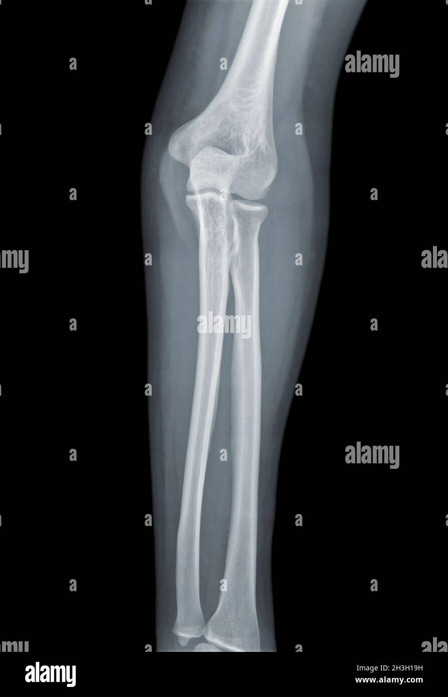 Elbow Xray negative Stock Photo Alamy