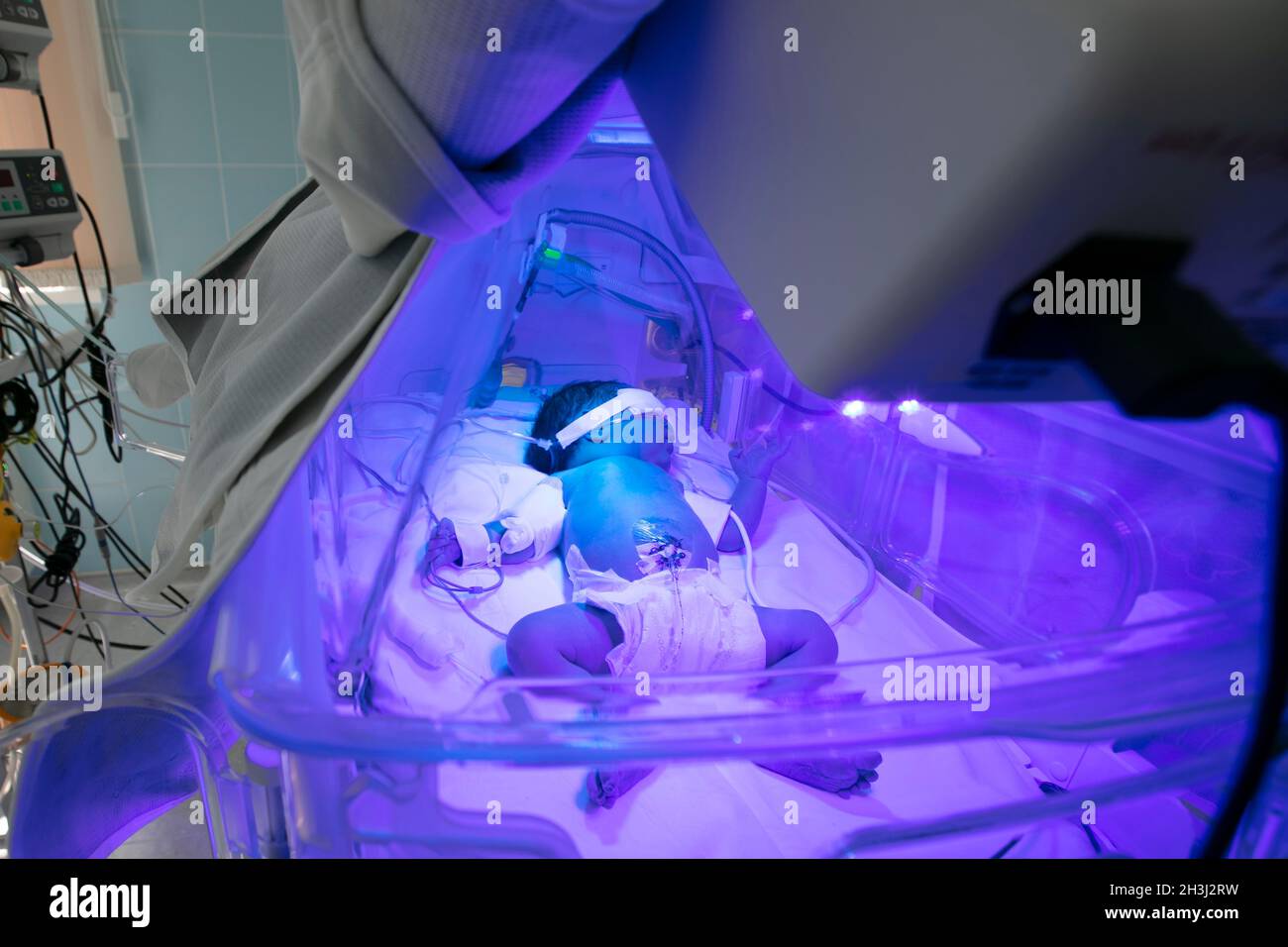 Newborn child baby having a treatment for jaundice under ultraviolet